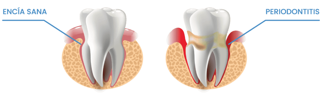 Encía-sana-vs-Periodontitis