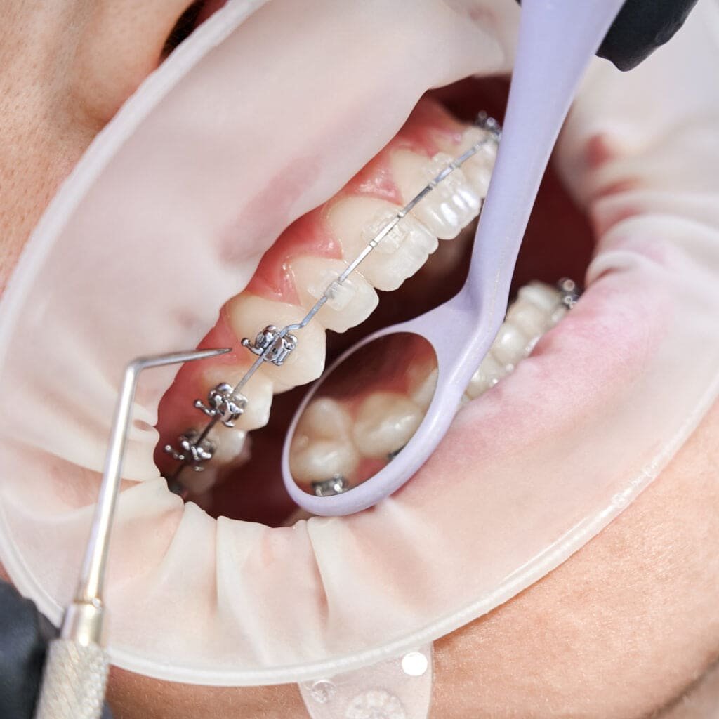 Close up of orthodontist using cofferdam and dental instruments while placing orthodontic brackets on patient teeth. Concept of stomatology, dentistry and orthodontic treatment.
