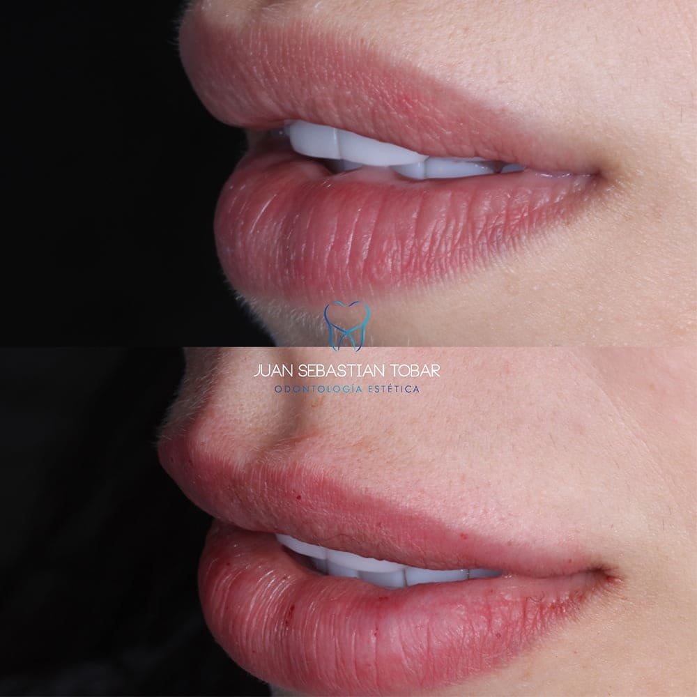 Acido hialuronico aumento de labios