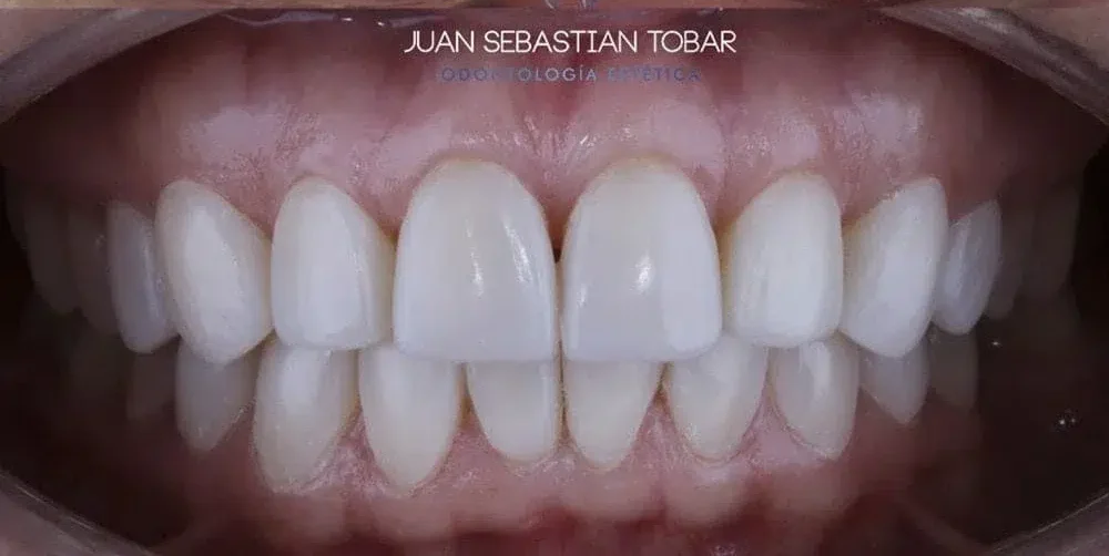 diseno-de-sonrisa-carillas-en-resina